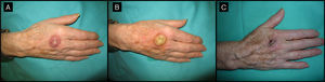Eighty-year-old woman with a 4-month-old tumor that was histologically and clinically consistent with keratoacanthoma (patient 5, Table 1). A, 2.5-cm tumor on the back of the right hand. B, Tumor after treatment with intralesional methotrexate; note the yellow color. C, Tumor, now measuring 1cm, at the time of surgery.