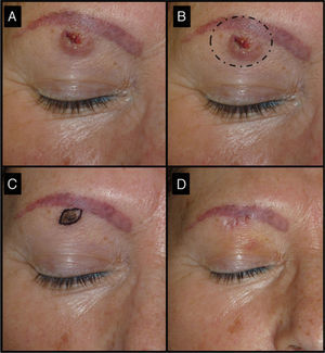 Fifty-two-old man with keratoacanthoma of 3 months’ duration under the right eyebrow (patient 3, Table 1). A, Tumor of 1.5cm at the baseline visit. B, Surgical excision of a tumor of this size would have required cutting the eyebrow. C, Tumor, now a small papule measuring 0.5cm, 1 month after treatment with intralesional methotrexate. The use of a small elliptical excision allowed the tumor to be removed without cutting the eyebrow, thereby achieving very good functional and cosmetic outcomes.