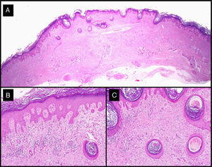 Histologic features of excised residual lesion after the administration of intralesional methotrexate (patient 3, Table 1). A-C, Dysplastic epidermis in association with a dense lymphohistiocytic infiltrate and some foreign body giant cells corresponding to the regression of the tumor following the administration of intralesional methotrexate (hematoxylin-eosin staining; original magnification: A, ×10; B, ×40; C, ×100).