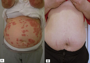 A, Papular eruption with tense blisters on the patient's abdomen. B, Condition of the patient at 6 weeks after delivery.
