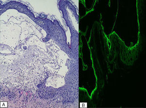 A, Subepidermal blister with eosinophils (hematoxylin-eosin, original magnification x10). B, Direct immunofluorescence: linear deposits of C3.