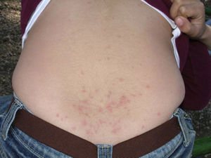 Similar lesions on the waist of the girl in the previous figure.