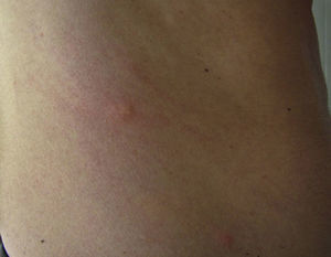 Papular dermatitis with scratch lesions and secondary eczematization on the side of a 25-year-old man.