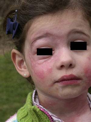 Intense contact urticaria with associated angioedema on the face and neck of a 5-year-old girl after playing in a sandpit close to pines infested with Thaumetopoea pityocampa.