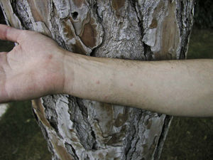 Contact urticaria on the forearm of a resin collector sensitized to Thaumetopoea pityocampa (positive skin prick test and detection of specific IgE in serum).