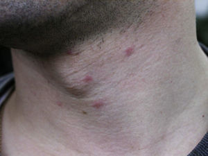 Inflammatory, infiltrated papules on the neck. They appeared on the day after a walk through a pine forest and persisted for 4 or 5 days with severe itching.