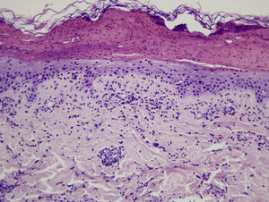 Histologic image showing a blister with leukocytic remains and coagulated serum. In the epidermis that forms the base, mild spongiosis and exocytosis of eosinophils can be seen. In the superficial dermis, there is a predominantly perivascular infiltrate of lymphocytes and eosinophils.