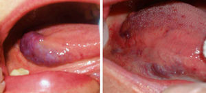 Venous malformation on the tongue (patient 7) before and after a session of Nd:YAG laser treatment (fluence, 200J/cm2; pulse duration, 30ms; spot diameter, 3mm).
