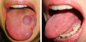 Venous malformation on the tongue (patient 8) before and after a session of Nd:YAG laser treatment (fluence, 200J/cm2; pulse duration, 35ms; spot diameter, 3mm).