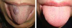 Venous malformation on the tongue (patient 9) before and after a session of Nd:YAG laser treatment (fluence, 200J/cm2; pulse duration, 35ms; spot diameter, 3mm).