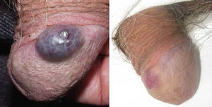 Venous malformation on the glans penis (patient 10) before and after a session of Nd:YAG laser treatment (fluence, 130J/cm2; pulse duration, 30ms; spot diameter, 5mm).