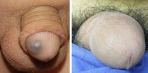 Venous malformation on the glans penis (patient 11) before and after a session of Nd:YAG laser treatment (fluence, 200J/cm2; pulse duration, 30ms; spot diameter, 3mm).