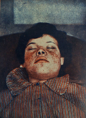 Color illustrations were very rare in Actas Dermo-Sifiliográficas until relatively recently. This image, which dates from 1935 and was one of the first, appeared in an article by López Ibor,55 director of the mental hospital in Valencia. It shows, albeit with the poor resolution of early color images, the facial angiofibromas of a patient with tuberous sclerosis.