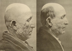 These 2 photogravures were used to illustrate an article by Nonell and Serrano44 in 1910 on the use of cryotherapy in the treatment of lupus vulgaris. In addition to the historical value of the pictures themselves, they are also one of the very first examples of the before and after photographs that now figure so prominently in our congresses. They are also interesting because they illustrate one of the pioneering articles on cryotherapy in European dermatologic literature.