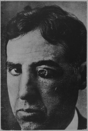 Photogravure from 1934 that illustrated one of the many articles describing the various forms of chancriform pyoderma that Covisa and Bejarano published in Actas Dermo-Sifiliográficas. The clinical presentation of the disease was unusual. The lesions, which were genital or extragenital (as seen in this illustration), mimicked a syphilitic chancre but had a different etiology. The importance of this clinical entity, practically forgotten today, must be seen in the context of the great prevalence of syphilis at that time.