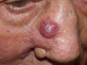 Nodule of firm consistency measuring 1cm, with multiple telangiectases in the upper part of the skin flap and infiltration in the lower part of the scar.