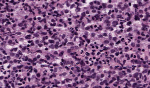 Cytology: diffuse neoplastic proliferation formed of round/oval medium-sized mononuclear cells with eosinophilic cytoplasm and basophilic nuclei, several of which had indentations (hematoxylin-eosin, original magnification ×40).