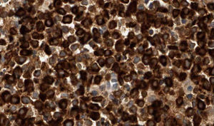 Immunohistochemical staining: diffuse cytoplasmic positivity for myeloperoxidase.