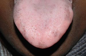 Case 1. Pigmentation limited to the fungiform papillae of the tongue, with irregularly distributed macules on the dorsum and lateral surfaces of the tongue in an indigenous African woman.