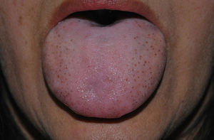 Case 2. Pigmented fungiform papillae of the tongue with a diffuse symmetrical pattern, predominantly affecting the lateral surfaces of the tongue in an indigenous South American woman.