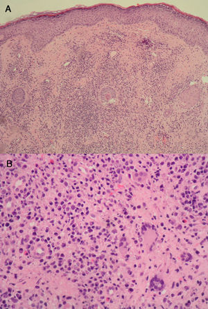 A,diffuse inflammatory infiltrate in the dermis. Epidermis with no significant histologic abnormalities (hematoxylin-eosin, original magnification, x25). B,lymphoplasmacytic inflammatory infiltrate containing isolated multinucleated giant cells (hematoxylin-eosin, original magnification, x200).