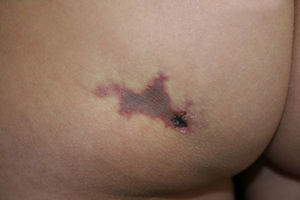 Violaceous livedoid plaque, with erythematous borders and a central scab located on the left buttock.