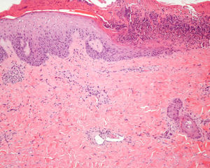 Epidermal necrosis corresponding clinically to the area of the scab, degeneration of dermal collagen, and fibrin clots in the lumen of the vessels of the superficial dermis (hematoxylin–eosin, original magnification x100).