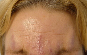 Violaceous linear plaques on the forehead.