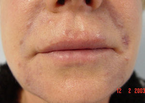 Infiltrated plaques in the nasolabial folds and on the upper lip.