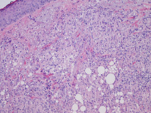 Sarcoid granulomas surrounding optically empty vacuolar structures (hematoxylin-eosin, original magnification ×40).