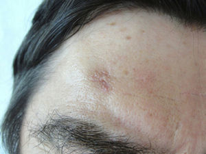 Asymptomatic lesion on the right frontal region.