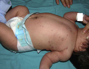 Multiple purpuric, erythematous papular and nodular lesions.