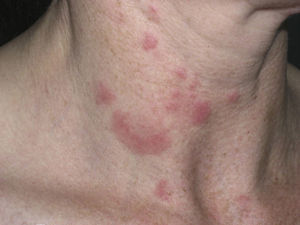Characteristic lesions of lupus erythematosus tumidus on the neck.
