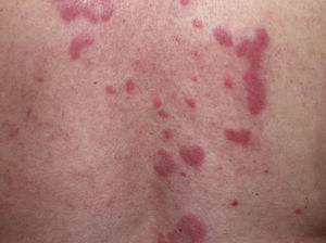 Characteristic lesions of lupus erythematosus tumidus on the back.