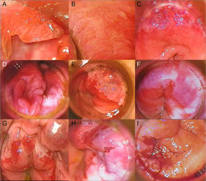 A, Condyloma in a patient with grade 1 anal intraepithelial neoplasia (AIN). B, Grade 2 AIN showing a papillomatous pattern with vascular punctation. C, Acetowhite plaque with abnormal vascularization in the upper right and left quadrants in a patient diagnosed with grade 2 AIN. D, Extensive acetowhite plaque with a cobblestone appearance in lower right and left quadrants in a patient with grade 2 AIN. E, Circumscribed acetowhite plaque in the upper left quadrant, corresponding to grade 2 AIN. F, Circumferential acetowhite plaques in a patient with grade 3 AIN. G, Acetowhite plaques and friable mucosa with hemorrhagic, erosive areas in a patient with grade 3 AIN. H, Acetowhite plaque and thick, tortuous vessels in upper quadrants. I, Exudative, hemorrhagic mass in a patient with infiltrating squamous cell carcinoma.