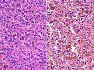 Histology of the tumor. A-B, Densely pigmented, atypical epithelioid (A) and spindle-shaped (B) melanocytes with a partly diffuse and partly nodular growth pattern (hematoxylin and eosin, original magnification ×4).