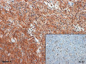 The lesion shows a high Ki-67 (MIB-1) cell proliferation index. There was marked immunoreactivity for Melan-A.
