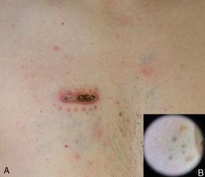 A, Physical examination of the area of the surgical scar in the right pectoral region revealed a 10-cm diameter plaque formed of grayish-blue macules a few millimeters in diameter. B, On dermoscopy, the macules consisted of round, homogeneous blue areas, with no globules, pigment network, or streaks.