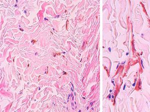 The grayish pigmented macule showed a proliferation of typical dendritic melanocytes diffusely spread through a stroma of thick collagen bundles.