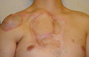 Appearance of the scar on the chest wall after 2 surgical interventions.