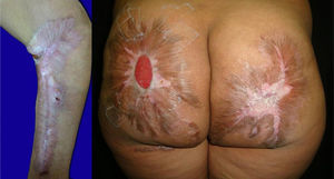 Photograph at 7 months of follow-up. There is reepithelialization of the lesions and scarring.