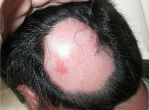 Alopecia areata plaque located on the cranial vertex after a year of adalimumab treatment.