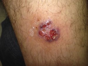 Pyoderma gangrenosum.