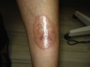 Plaque of necrobiosis lipoidica with initial ulceration.