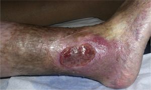 Typical venous ulcer.