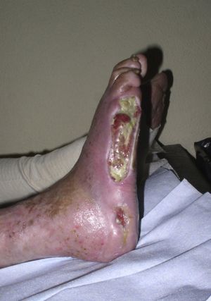 Arterial ulcer.