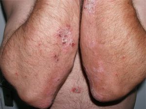 Pustules on the residual psoriasis plaques.