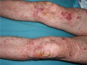 Episode of generalized pustular psoriasis 72hours after performance of the tuberculin skin test.