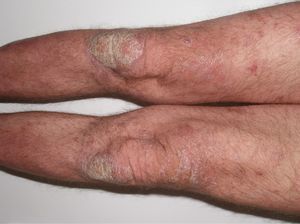 Improvement of the lesions after 2 weeks of treatment with ciclosporin.
