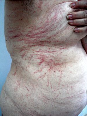 Crisscrossing linear erythematous lesions, primarily on the trunk.